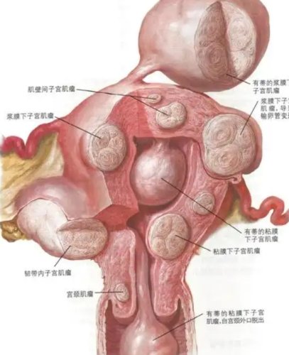 子宮肌瘤手術費用