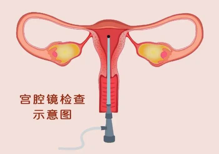 子宮鏡檢查