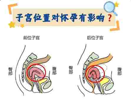 子宮後傾症狀