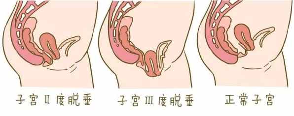子宮下垂