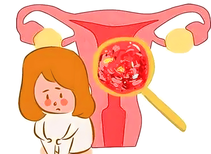 子宮 肌 腺 症