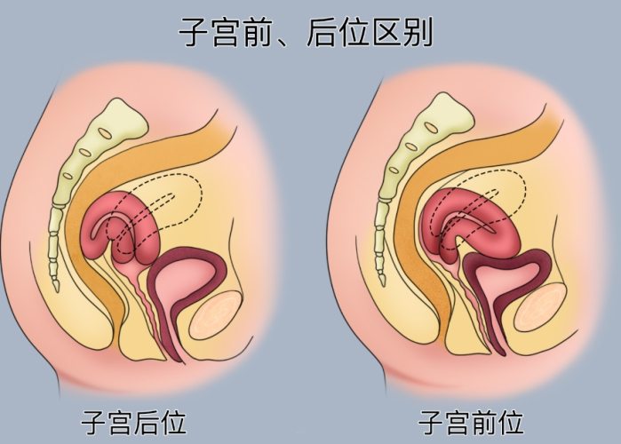 子宮後傾