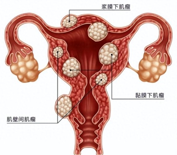 子宮肌瘤手術