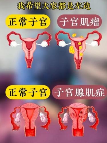 子宮腺肌症