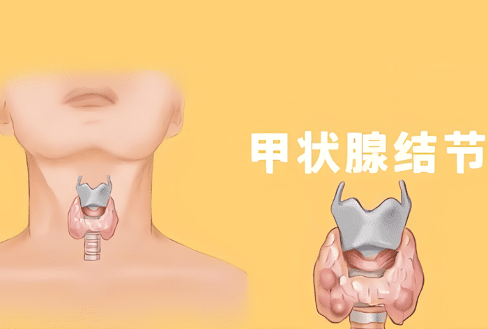 甲狀腺 結節