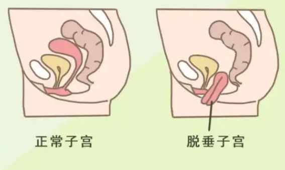 子宮下垂預防