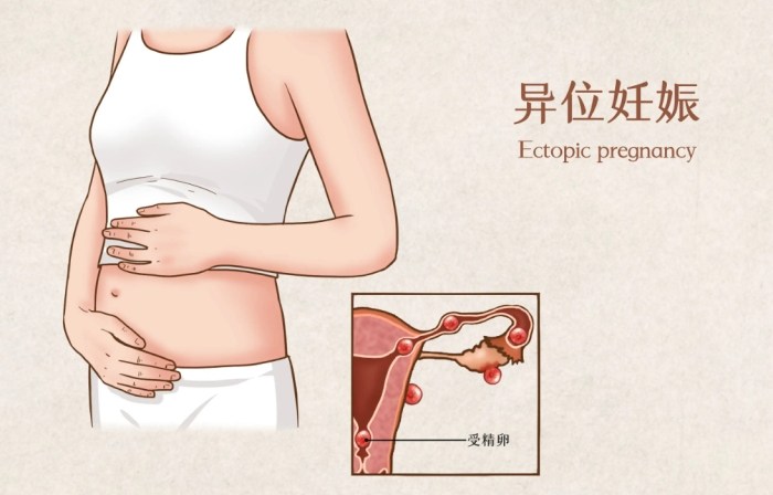 子宮內膜異位治療