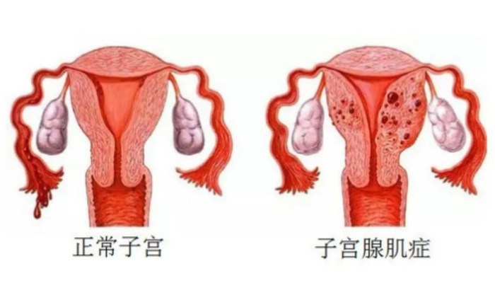 子宮腺肌症原因