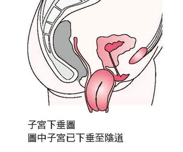 子宮下垂原因