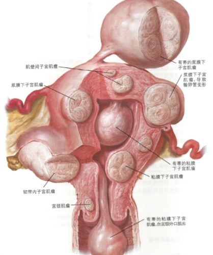子宮肌瘤手術方式