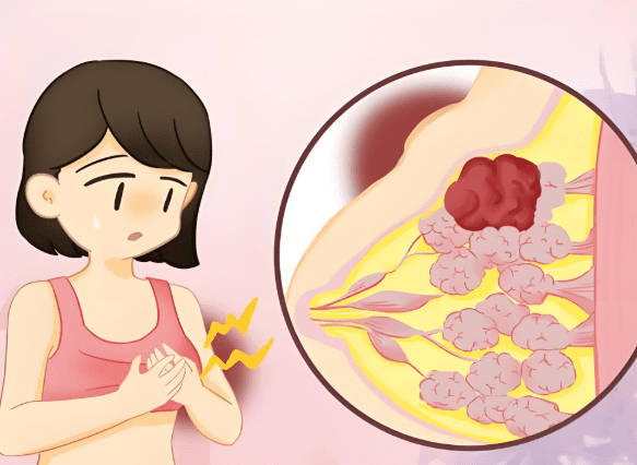 乳腺炎常見病因