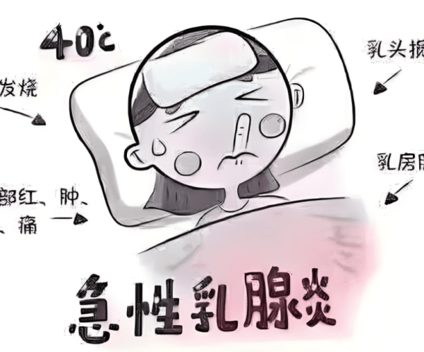 預防乳腺炎