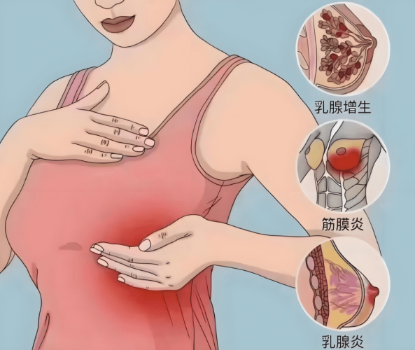 乳腺炎症狀​