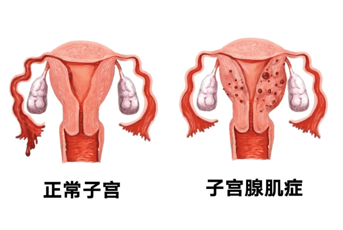 子宮肌腺症原因