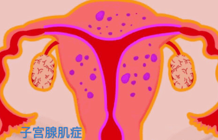 子宮肌腺症飲食
