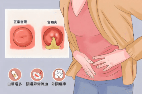 子宮發炎治療