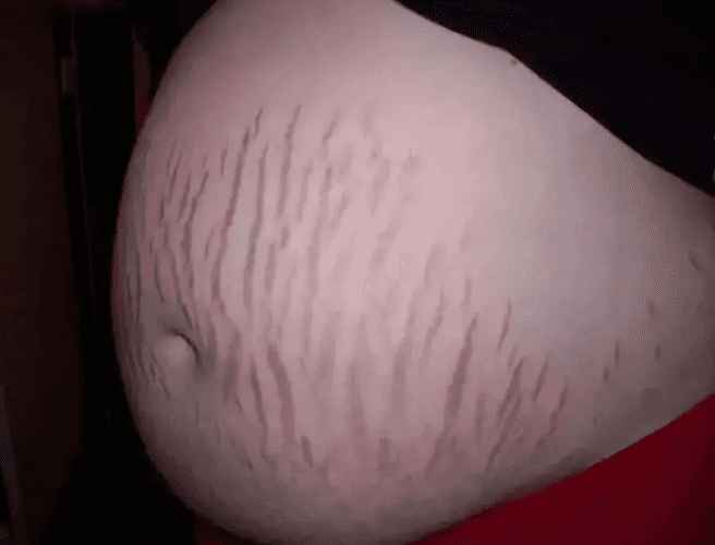 妊娠紋