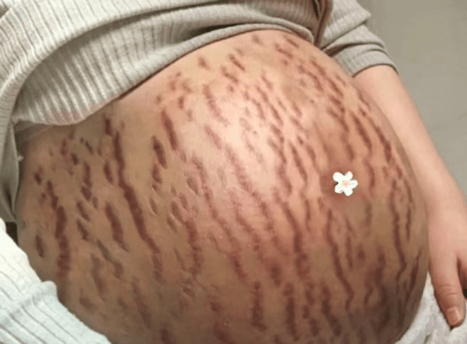 妊娠紋