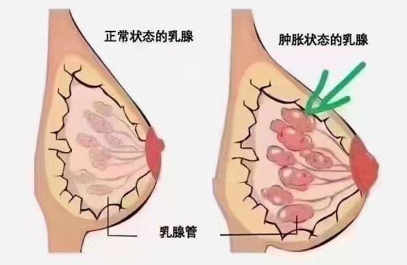乳腺炎原因