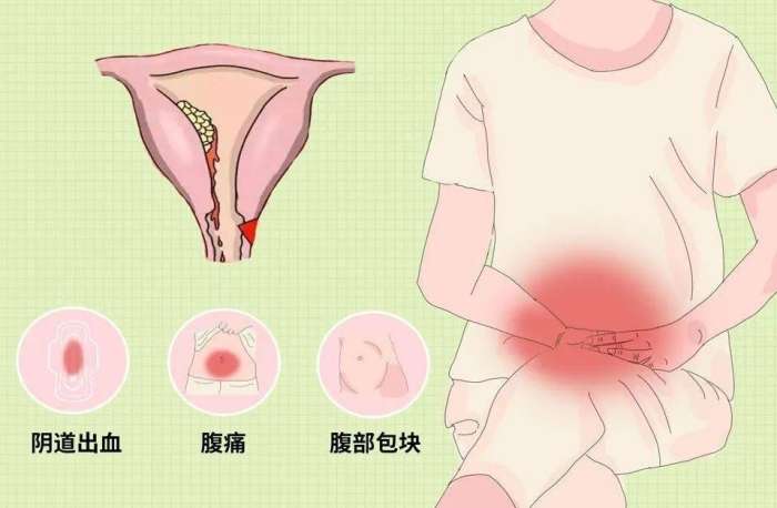 子宮內膜增生飲食禁忌