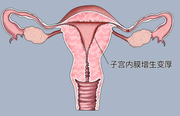 子宮內膜增生